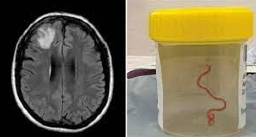 Mujer tenía una lombriz en su cerebro